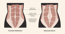 Diastasis Recti & The Tupler Technique 